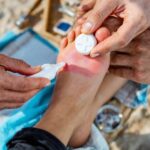 Piqûre de vive : comment soulager immédiatement la douleur intense