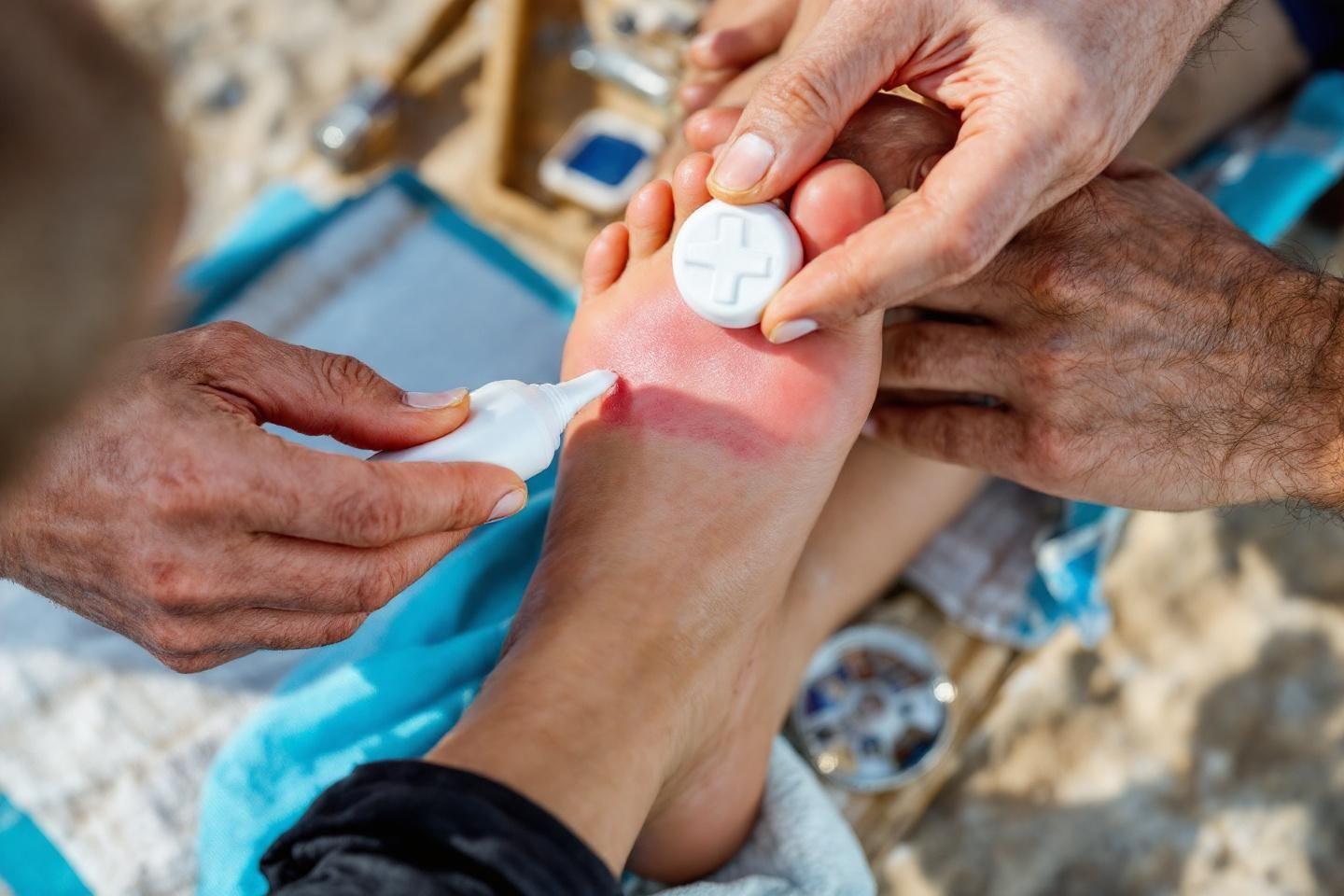 Piqûre de vive : comment soulager immédiatement la douleur intense